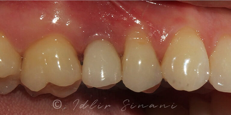 Dental_implant_in Albania2