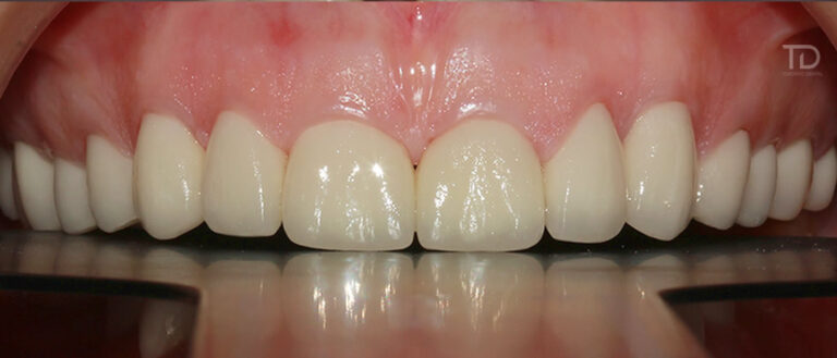 Diana_smilemakeover_emax_crowns1