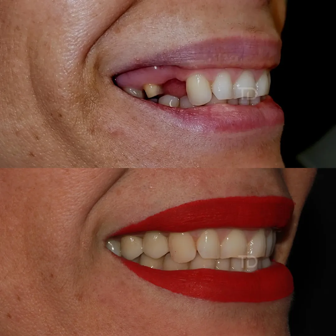 Emax dental bridge Dental Implants cost Abroad Uk dental tourism source