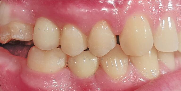 Implant_before_and_after_A12