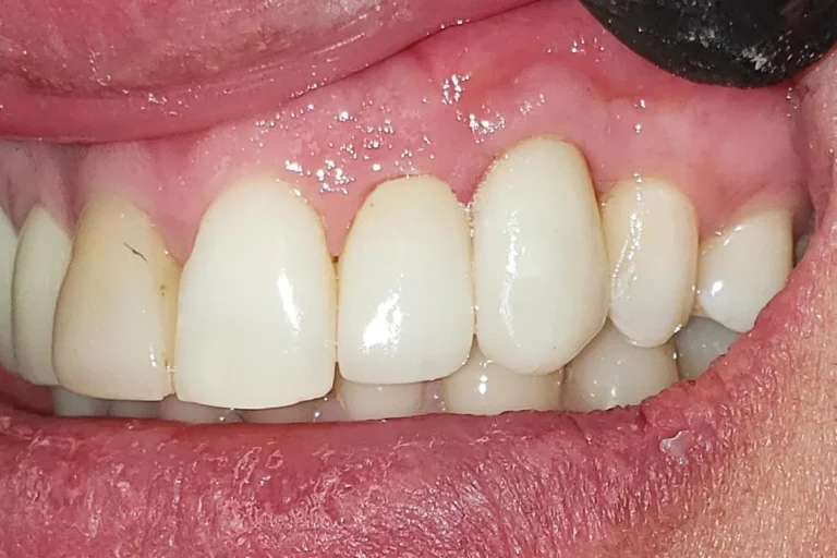 dental implant a