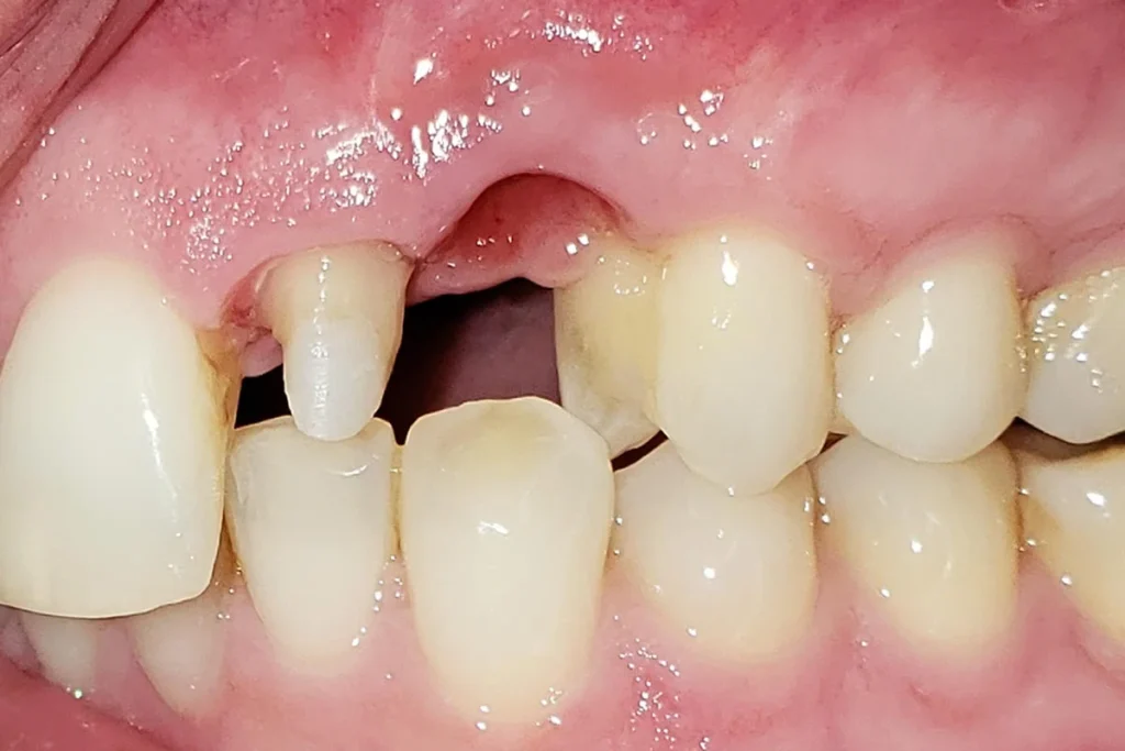 dental implant front teeth agj